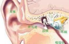 鼓膜炎是什么